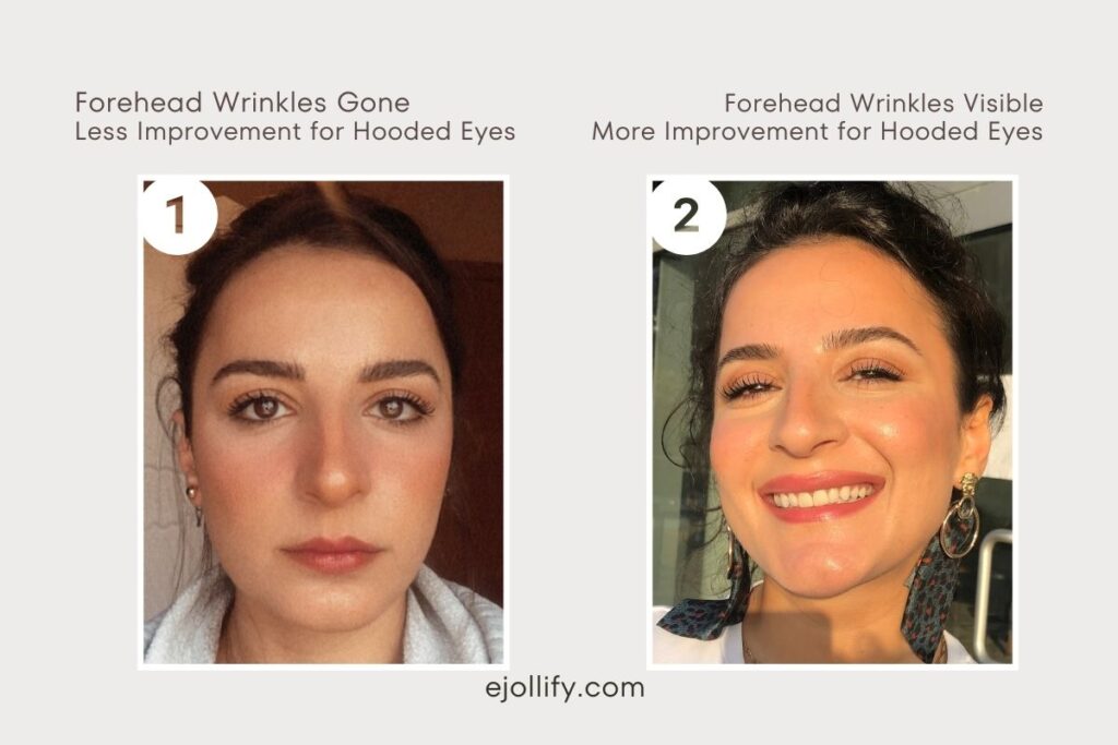 Before After Face Photo - Botox for Hooded Eyes