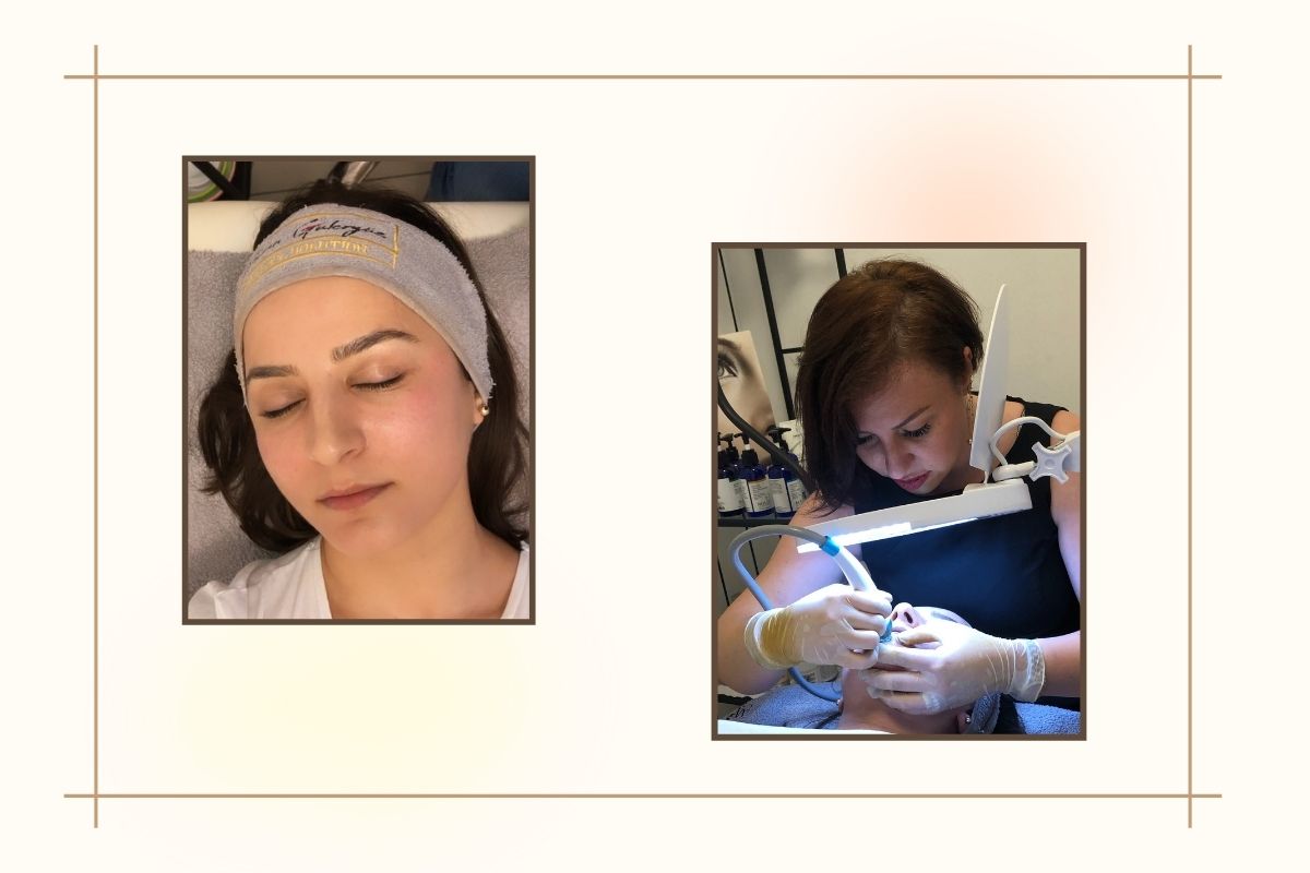 Best Facial For Congested Skin - Hydrafacial for Congested Skin