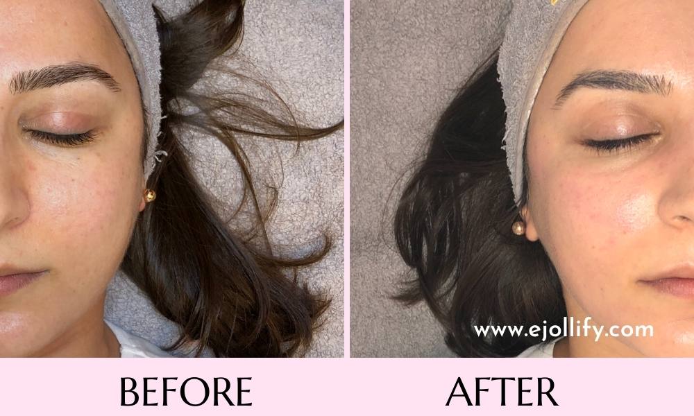 Hydrafacial for Congested Skin - Before  After
